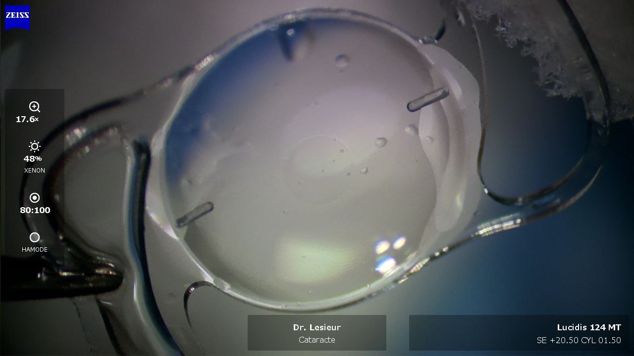 Implant intraoculaire de dernière génération