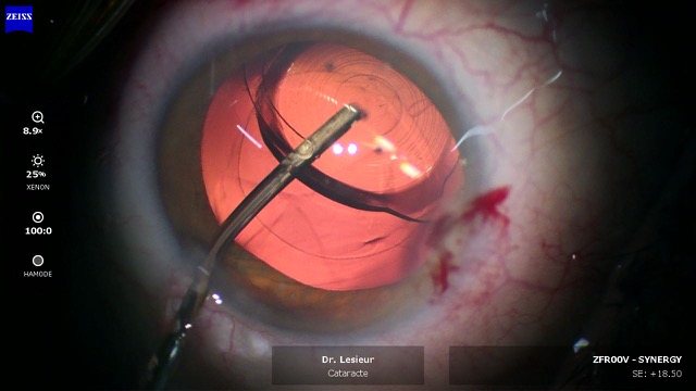 Chirurgie Prelex, remplacement du cristallin